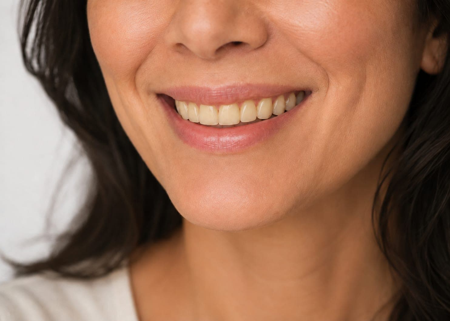 Crowding after childhood braces — Before