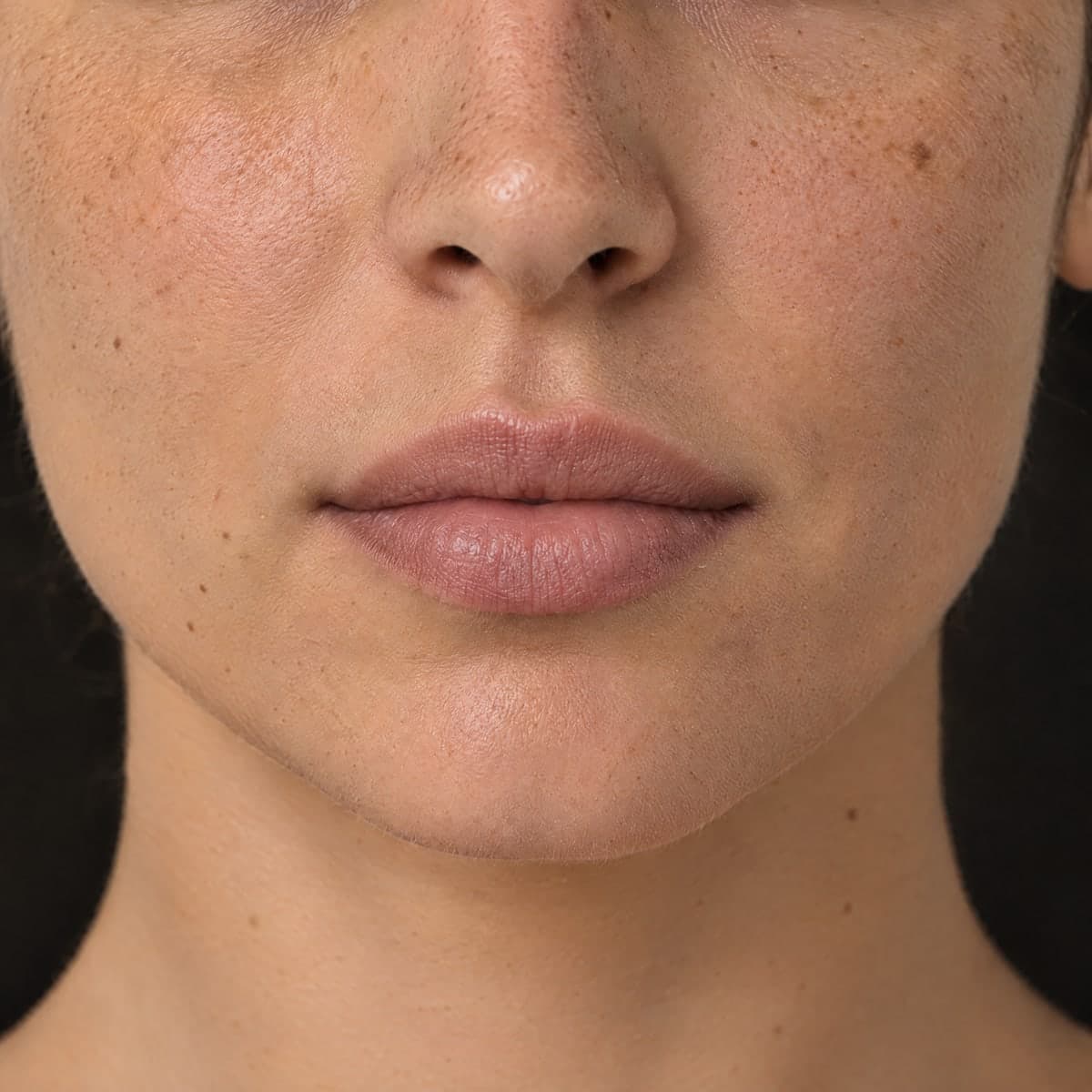 The same lips and chin, the same light, after a filler.